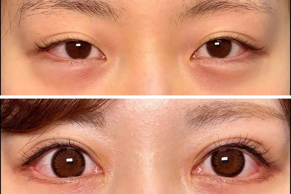 目尻切開＋目頭切開　那覇