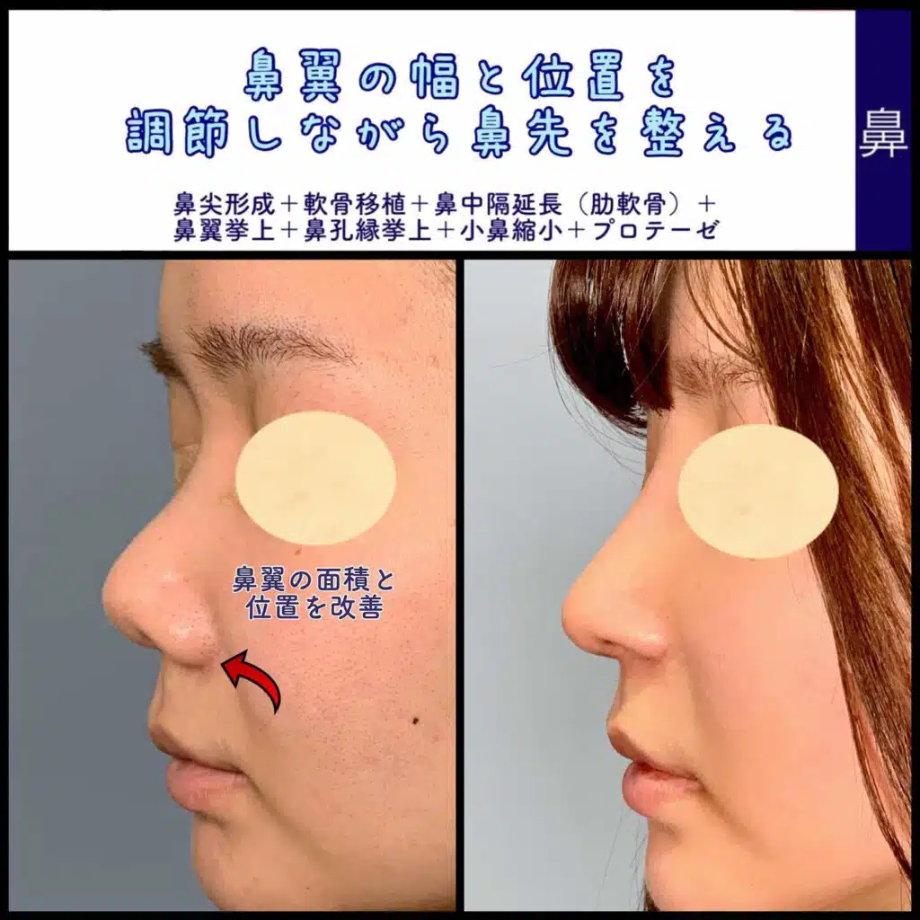 鼻尖形成+軟骨移植+鼻中隔延長(肋軟骨)+鼻翼挙上+鼻孔縁挙上+小鼻縮小+プロテーゼ 那覇