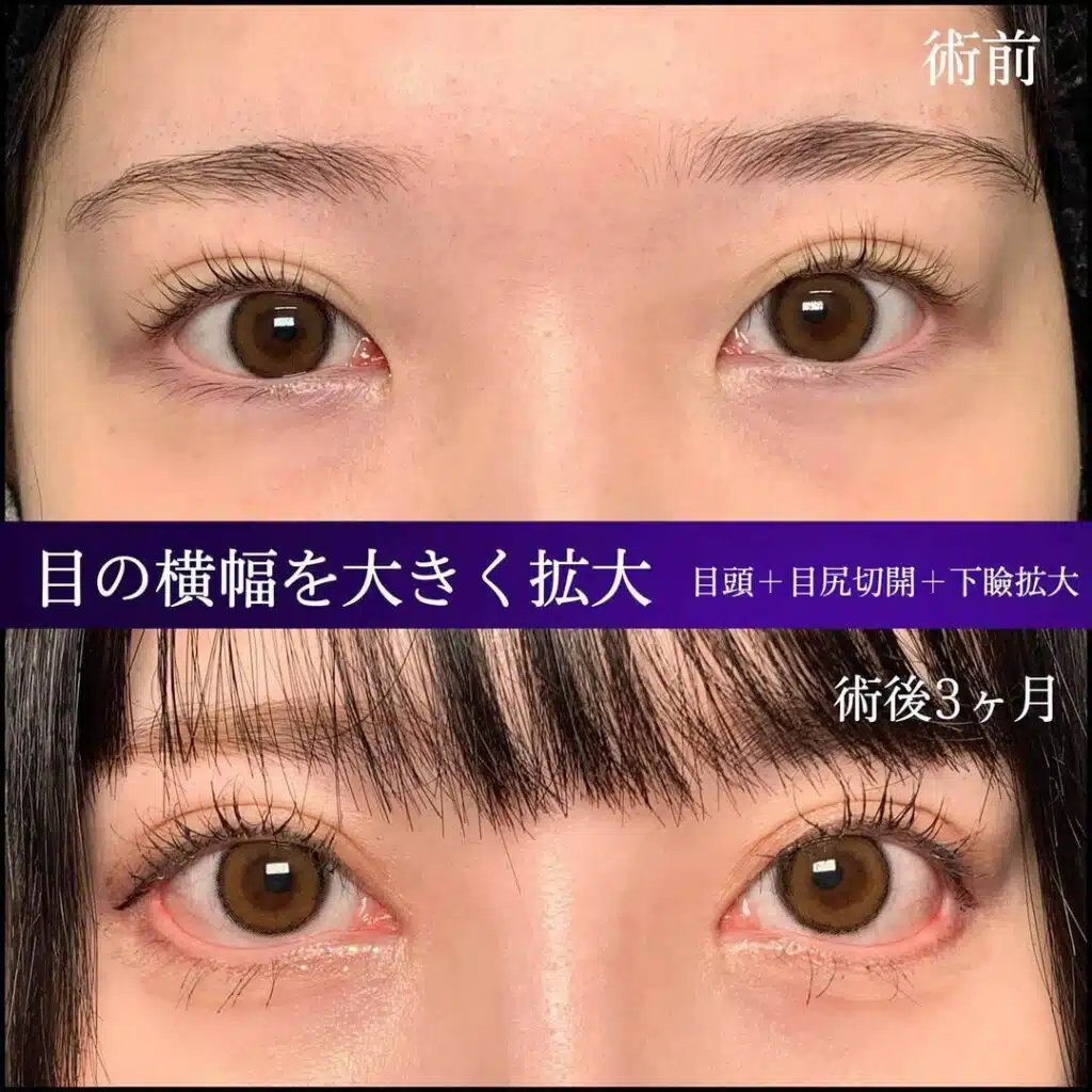 目頭＋目尻切開＋下瞼拡大　那覇