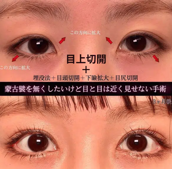 目上切開+埋没法+目頭切開+下瞼拡大+目尻切開　那覇