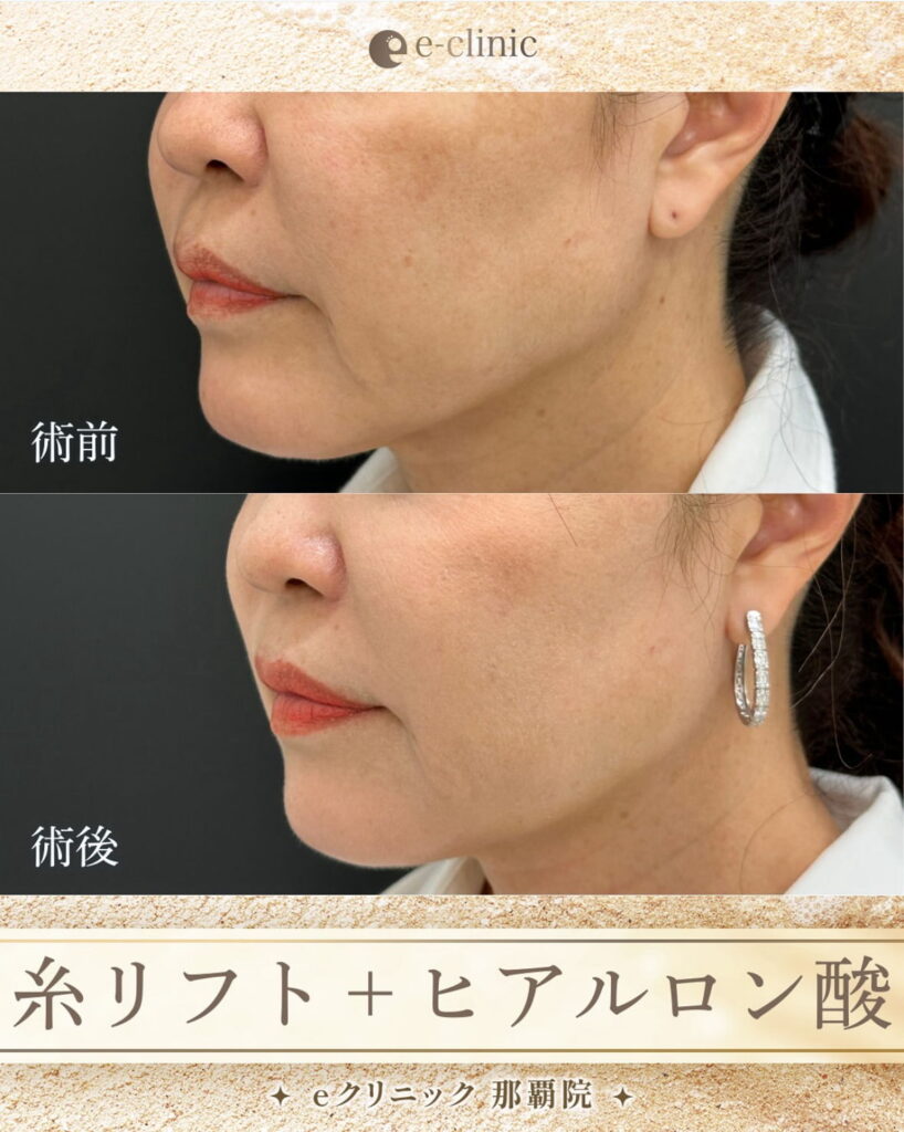 糸リフトとヒアルロン酸の山本医師の症例写真 (2)