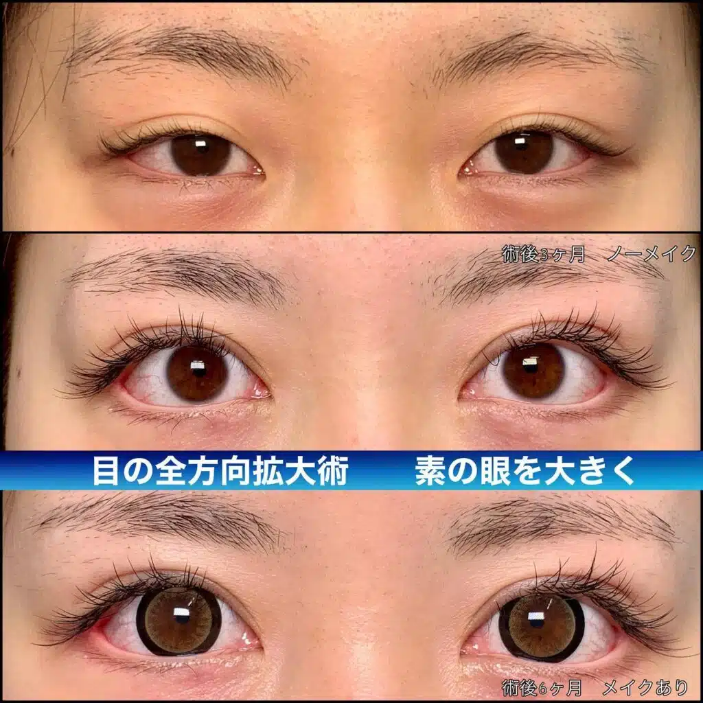 目の全方向拡大術　那覇