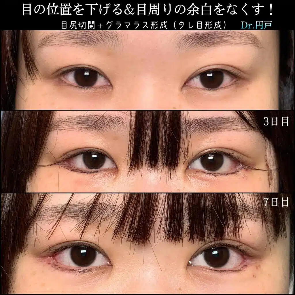 目尻切開＋グラマラス形成（タレ目形成）　那覇