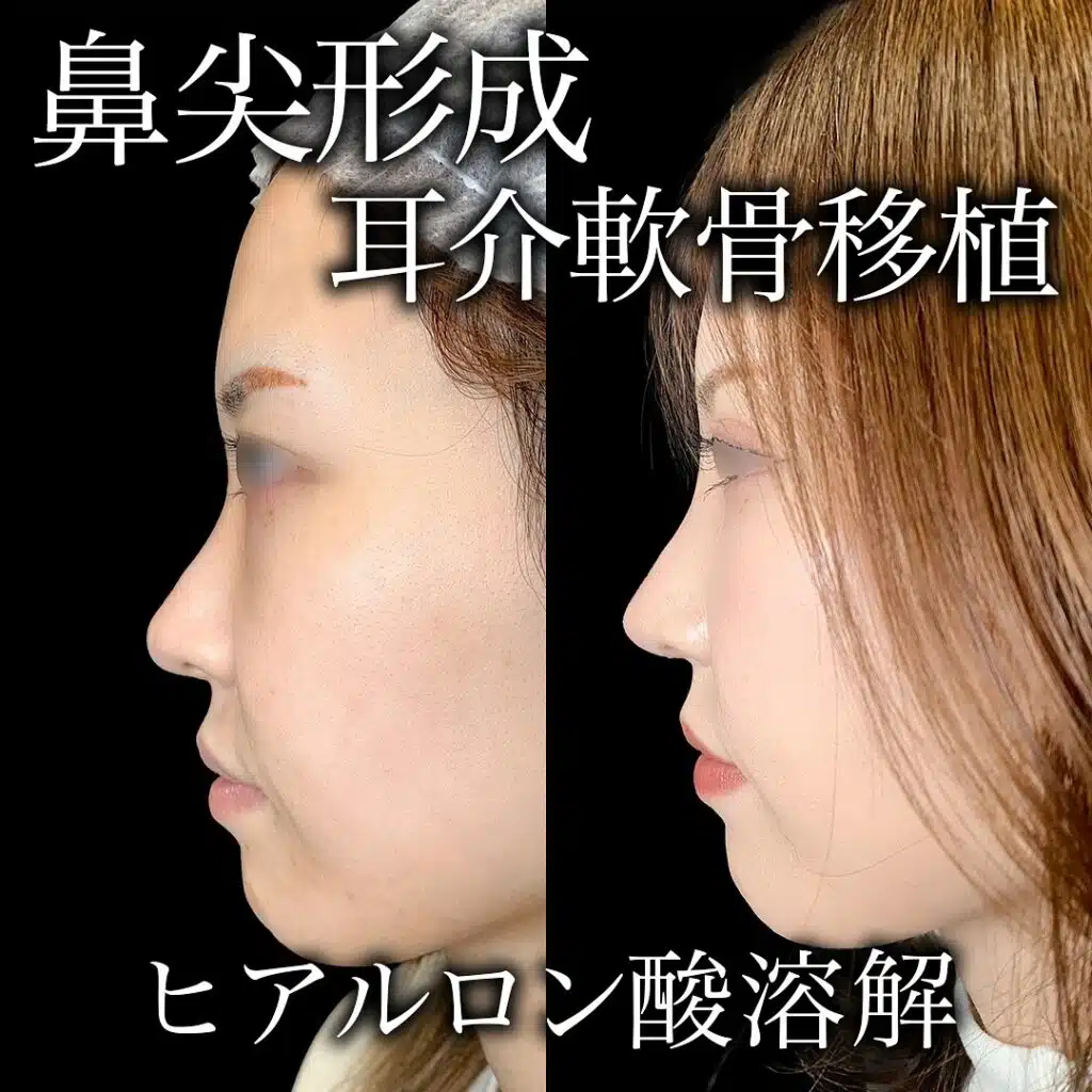 鼻尖形成と耳介軟骨移植　那覇