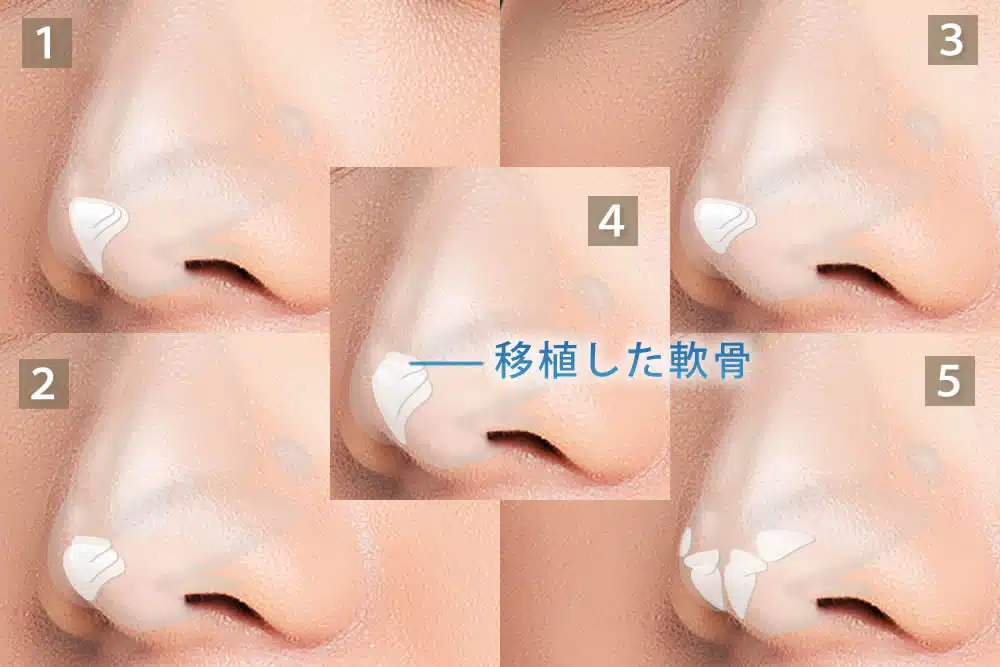鼻尖軟骨移植の5つのパターン　那覇