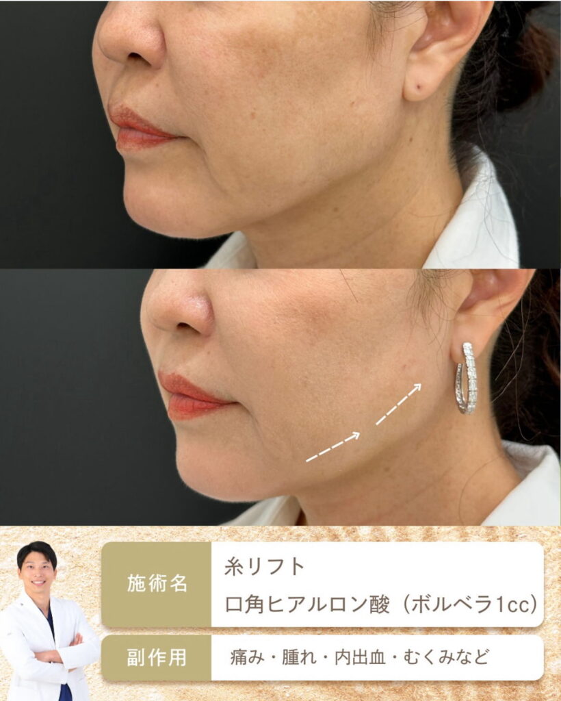 糸リフトとヒアルロン酸の山本医師の症例写真 (3)