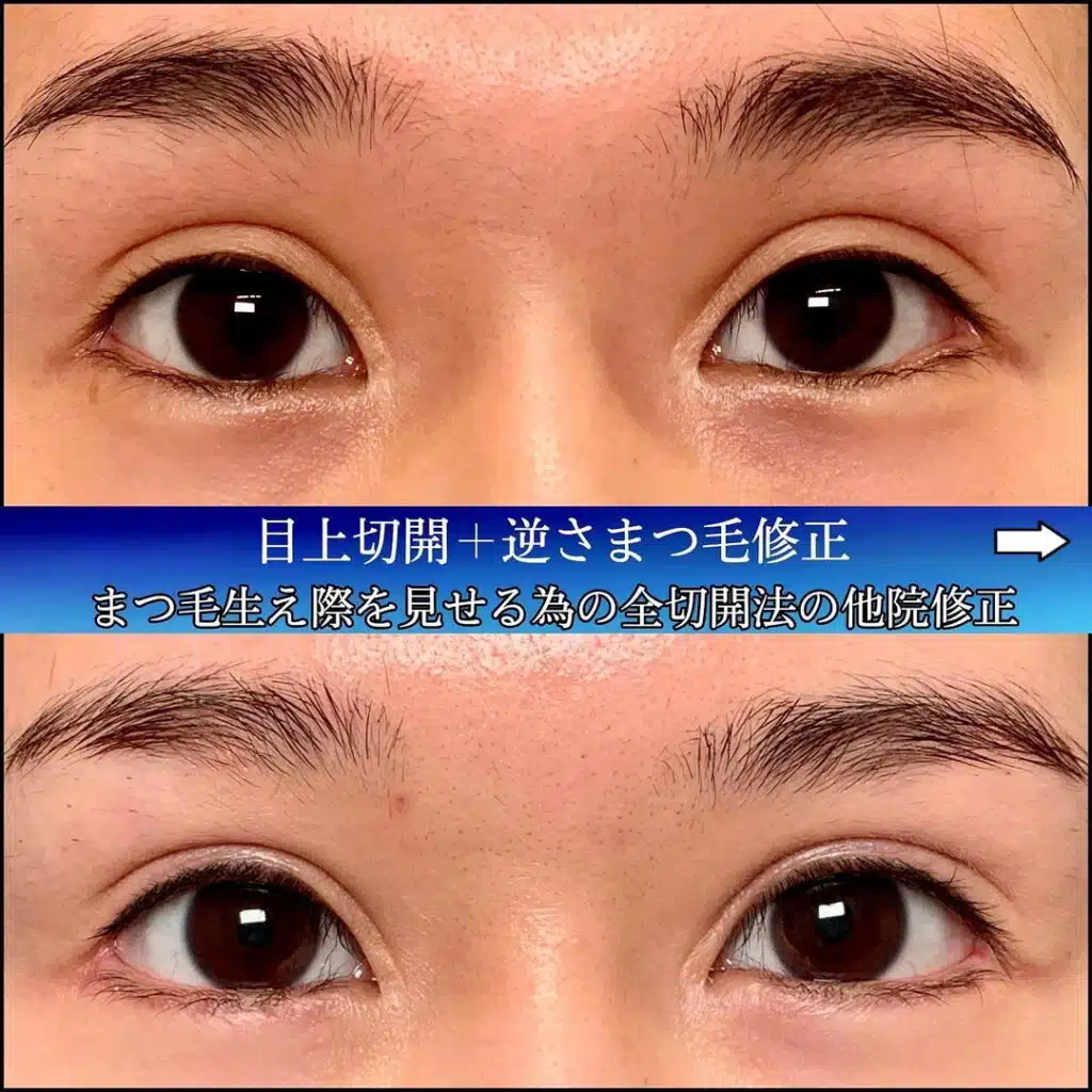 目上切開+逆さまつ毛修正　那覇