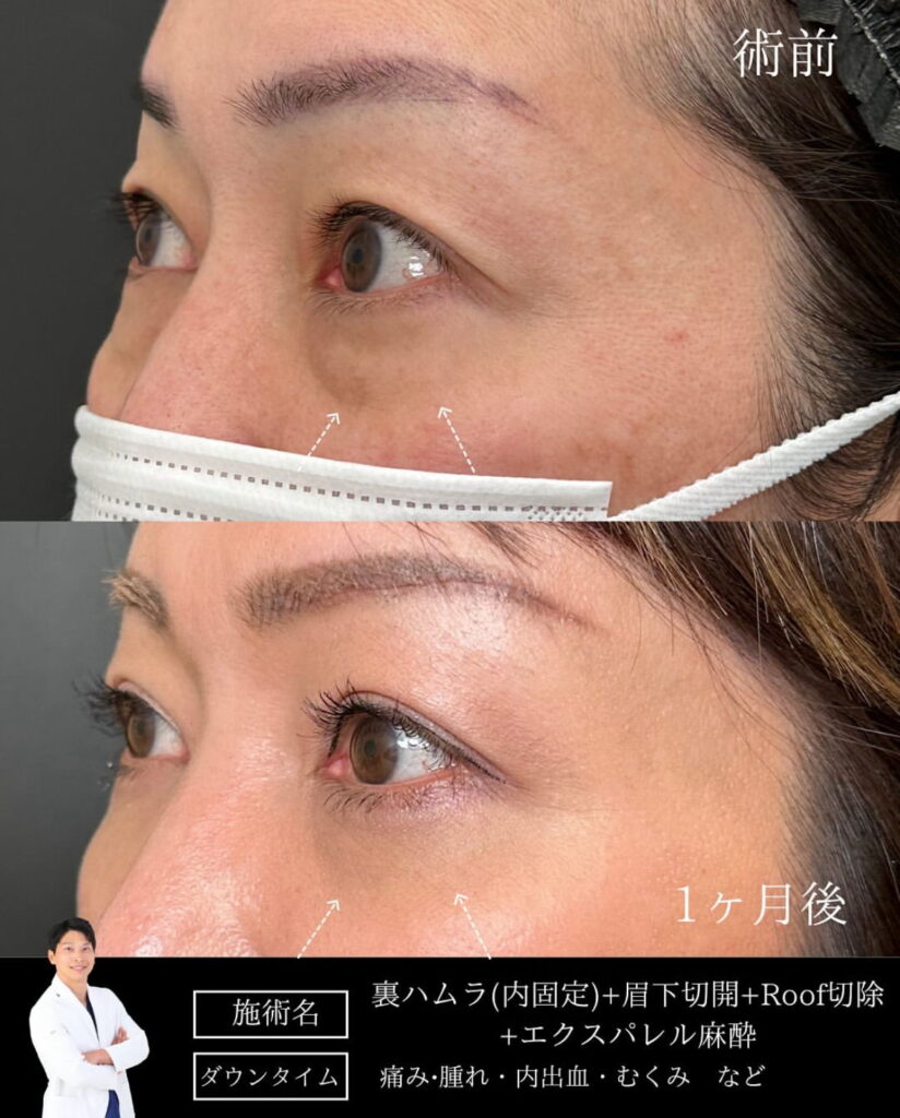 裏ハムラと眉下切開の山本医師の症例写真 (1)