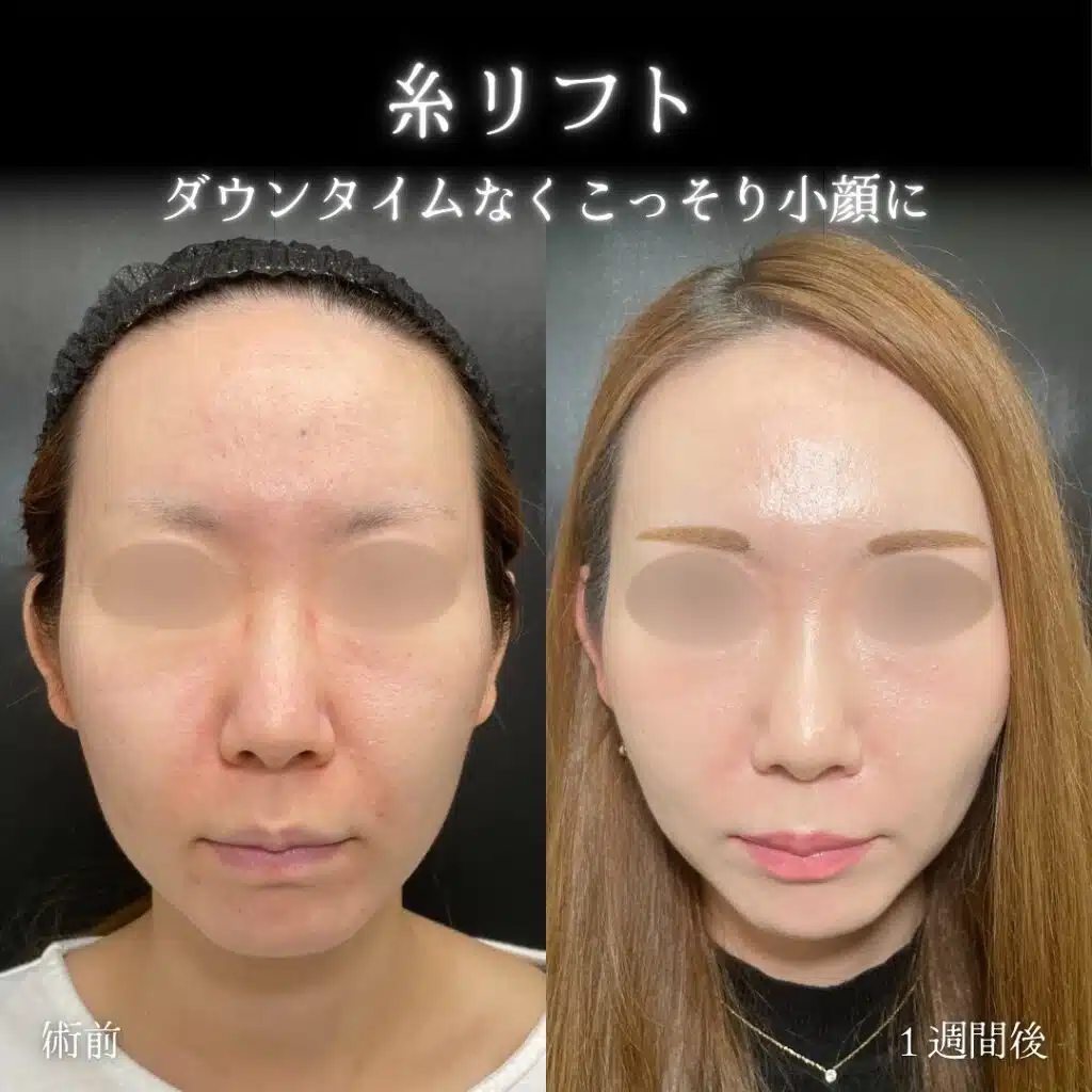 糸リフト　那覇