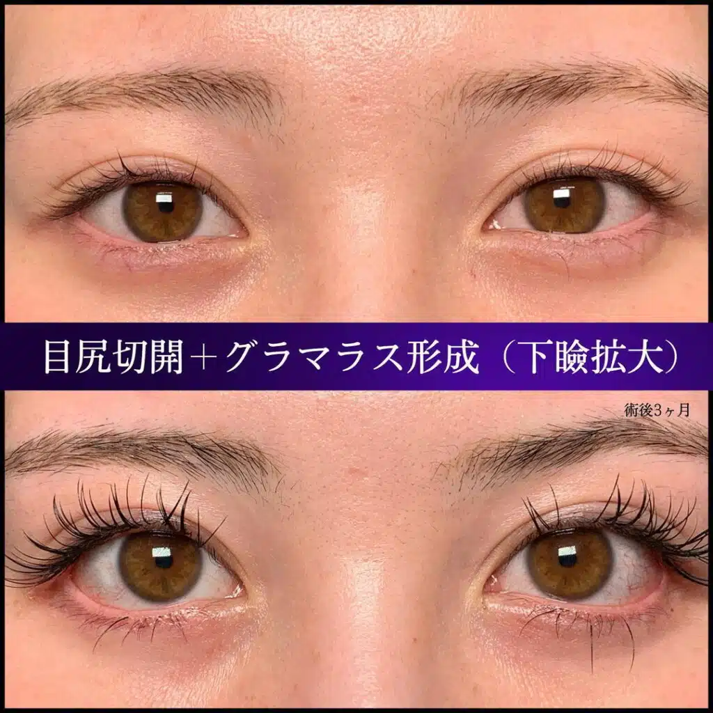 目尻切開×グラマラス形成（下瞼拡大）　那覇