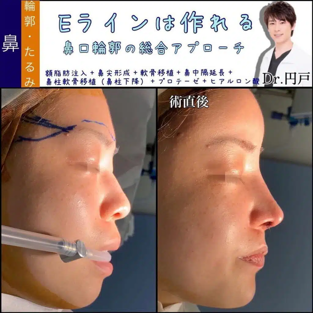 額脂肪注入+鼻尖形成+軟骨移植+鼻中隔延長+鼻柱軟骨移植(鼻柱下降)+プロテーゼ+ヒアルロン酸 那覇