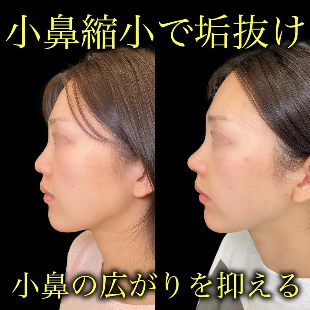 小鼻縮小
