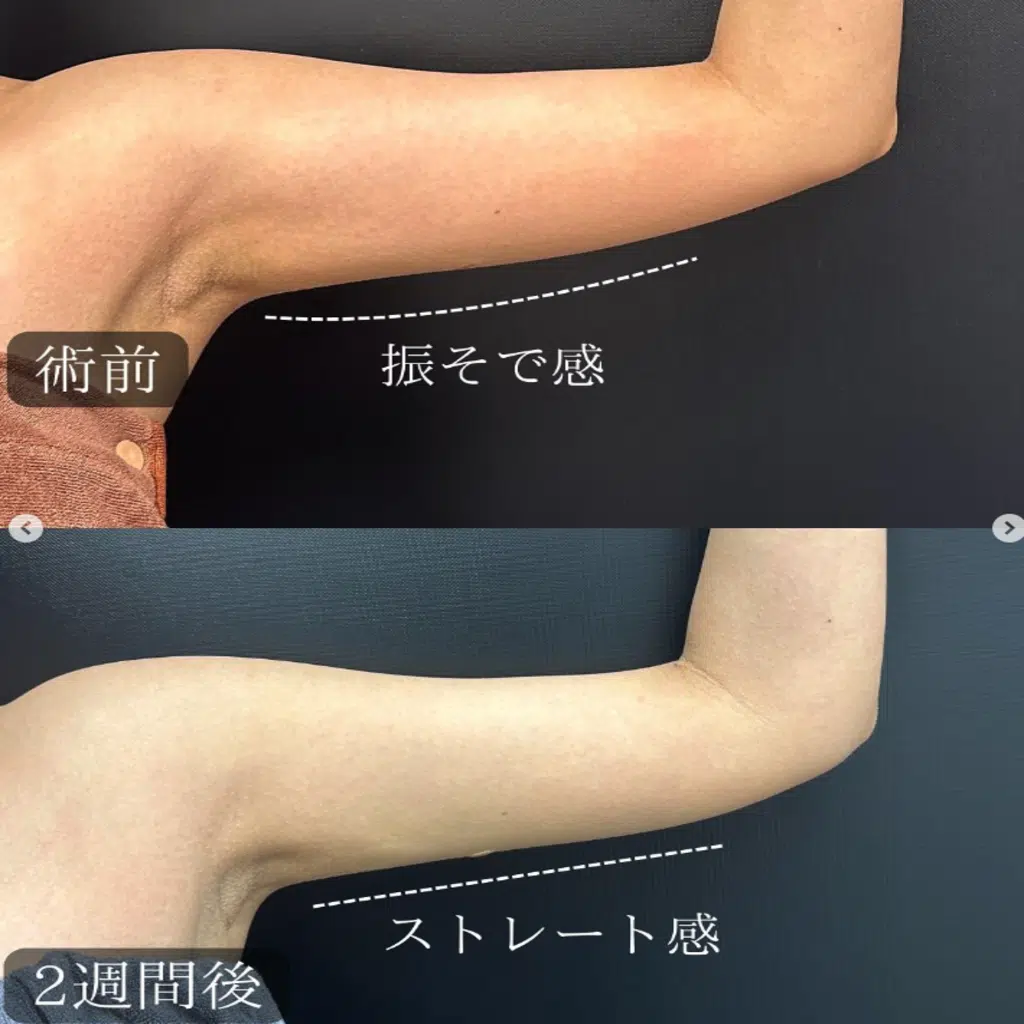 二の腕の脂肪吸引　那覇