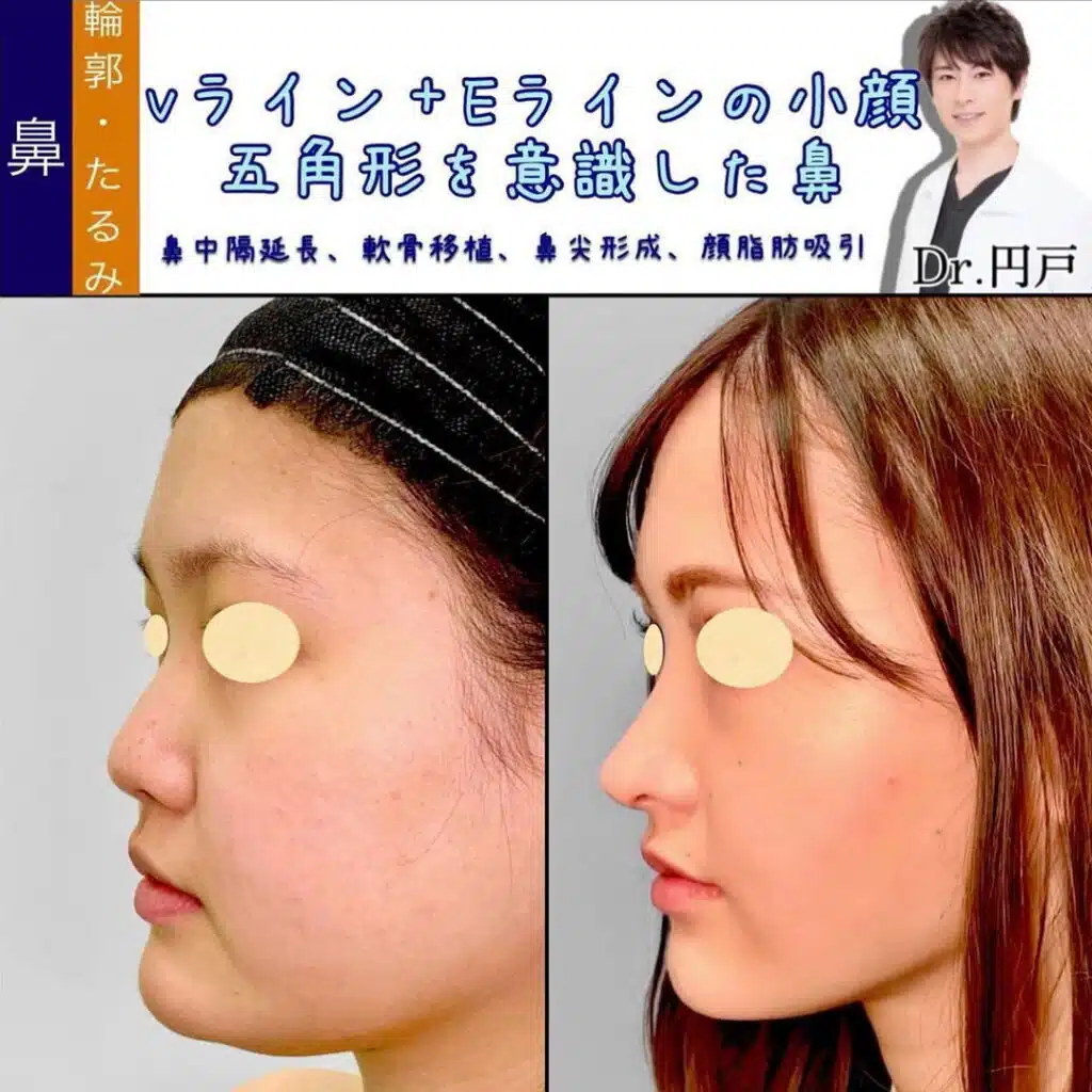 鼻中隔延長、軟骨移植、鼻尖形成、顔脂肪吸引　那覇