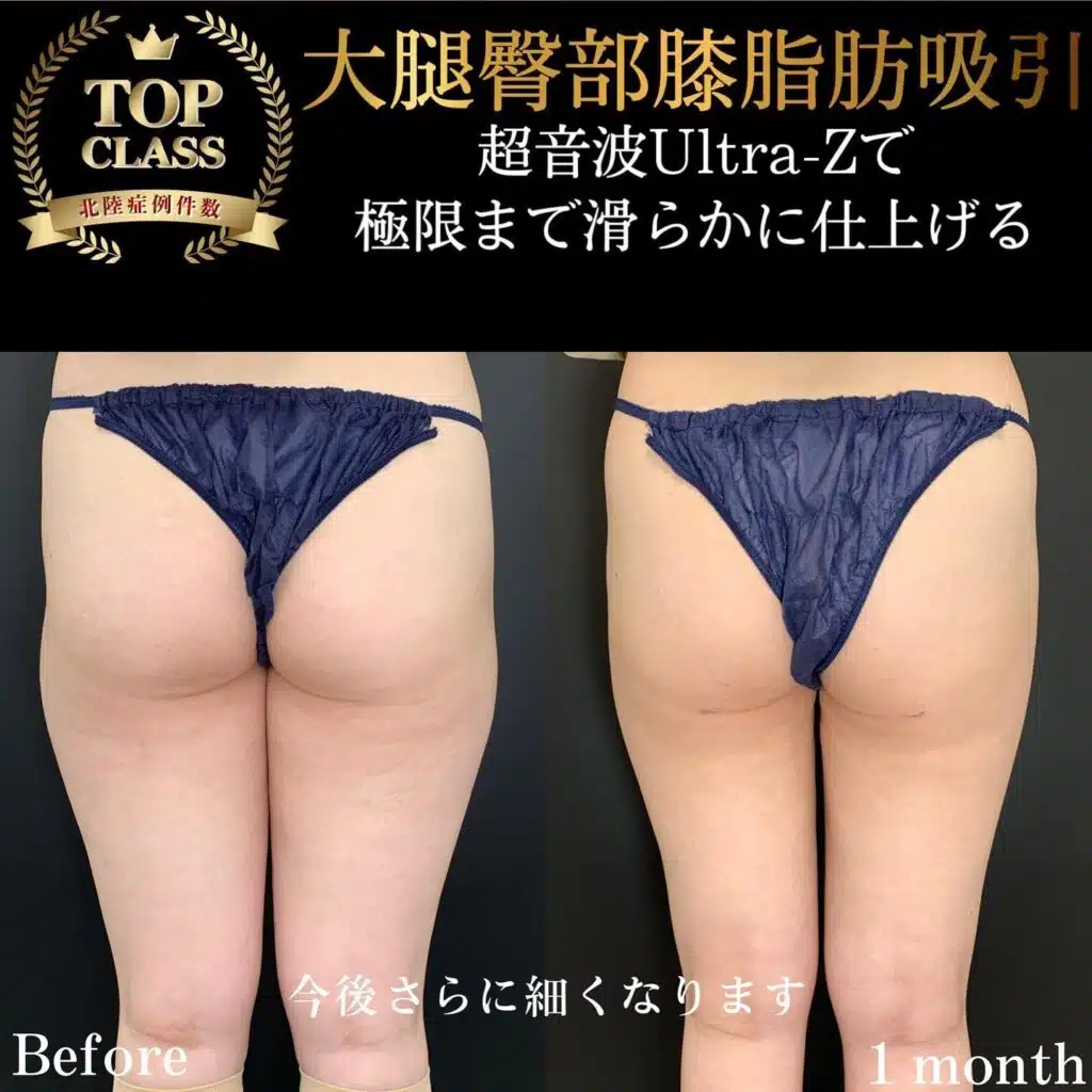 大腿臀部膝脂肪吸引　那覇