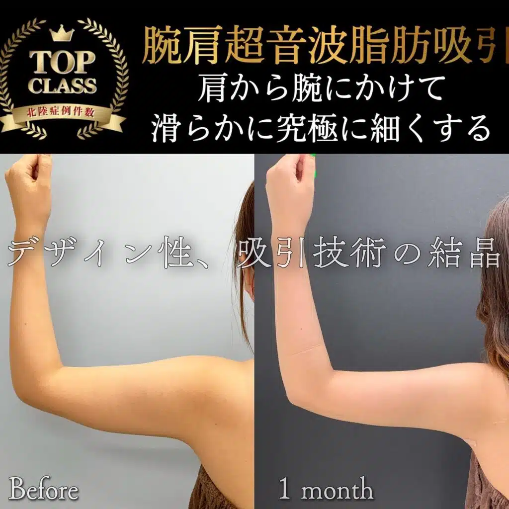 腕肩超音波脂肪吸引　那覇