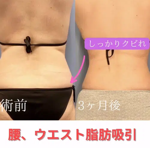 腰、ウエスト脂肪吸引　那覇