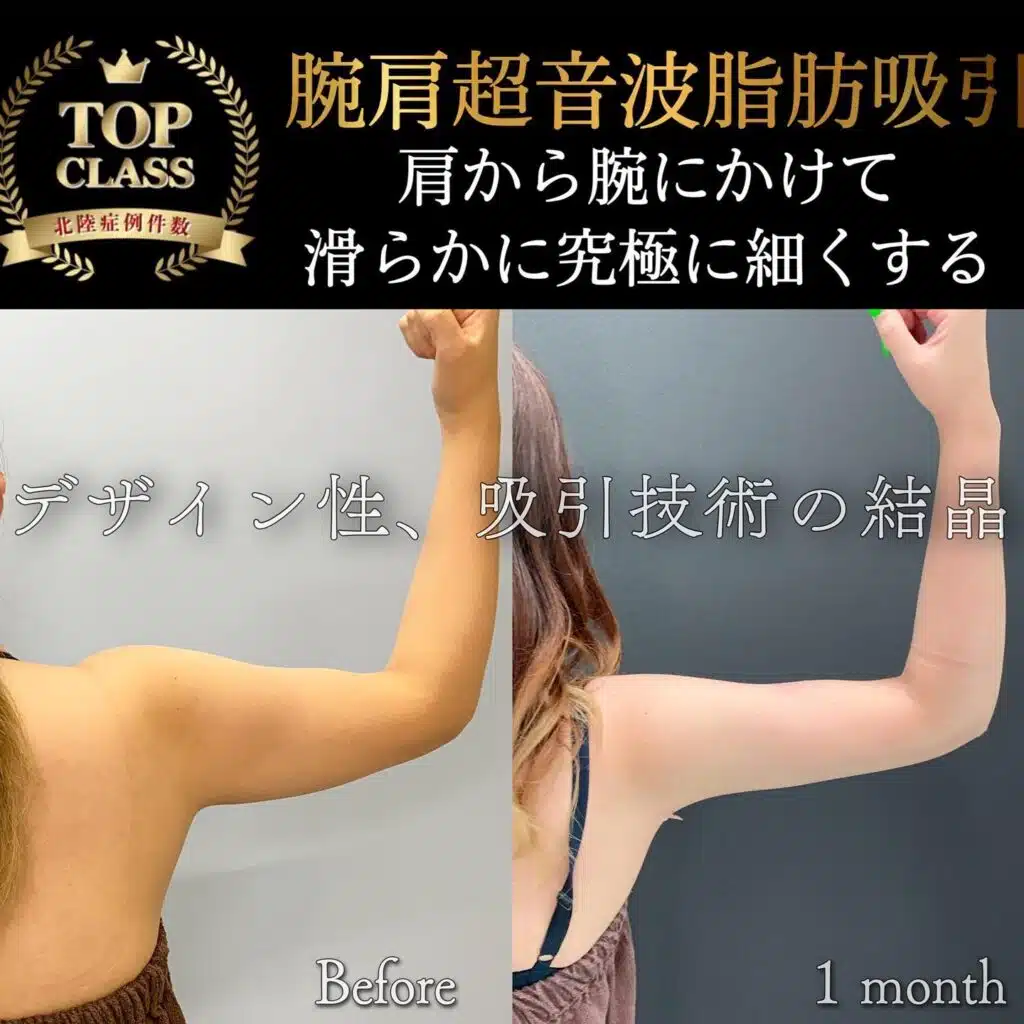 腕肩超音波脂肪吸引　那覇