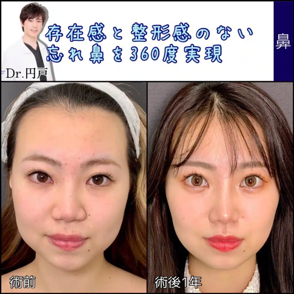 鼻尖形成＋軟骨移植＋鼻中隔延長、法令線基部人口真皮、鼻背部軟骨以上、小鼻縮小 (2)　那覇