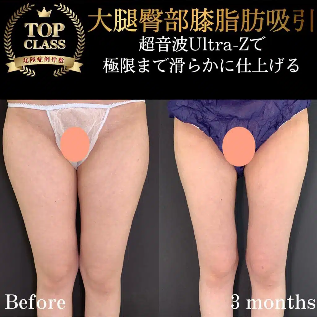 大腿臀部膝脂肪吸引　那覇