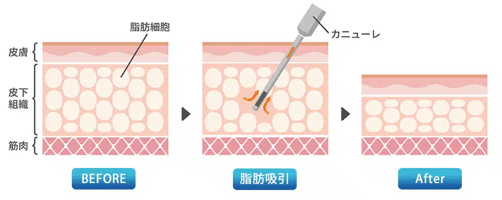 脂肪吸引　図解　那覇