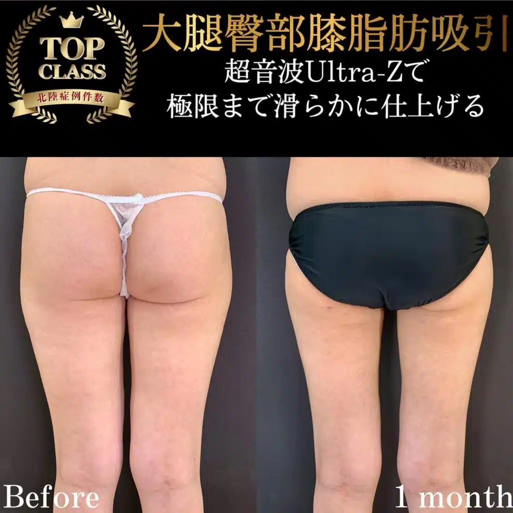 大腿臀部膝脂肪吸引　那覇