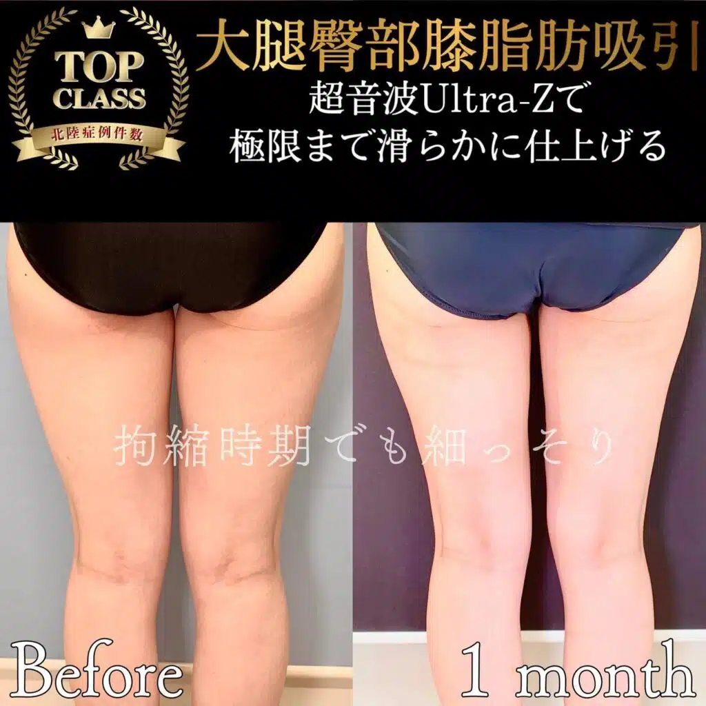 大腿臀部膝脂肪吸引　那覇