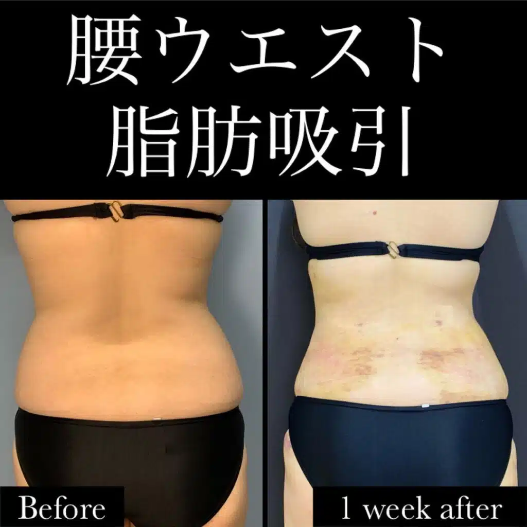 腰ウエスト脂肪吸引　那覇