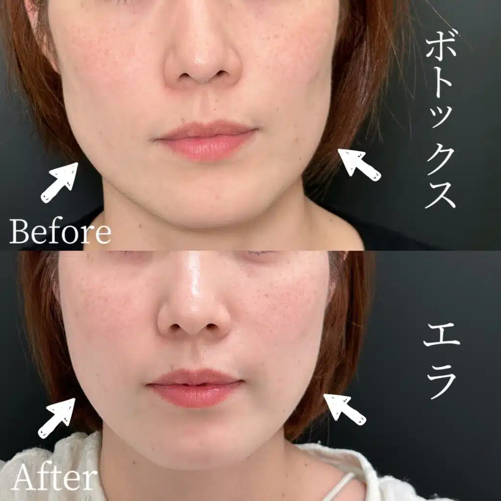 エラボトックス　那覇