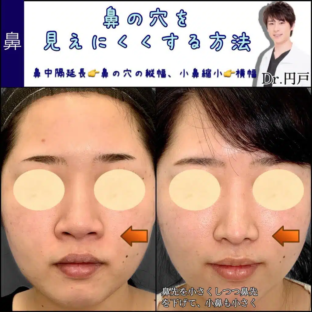 鼻中隔延長　小鼻縮小　那覇