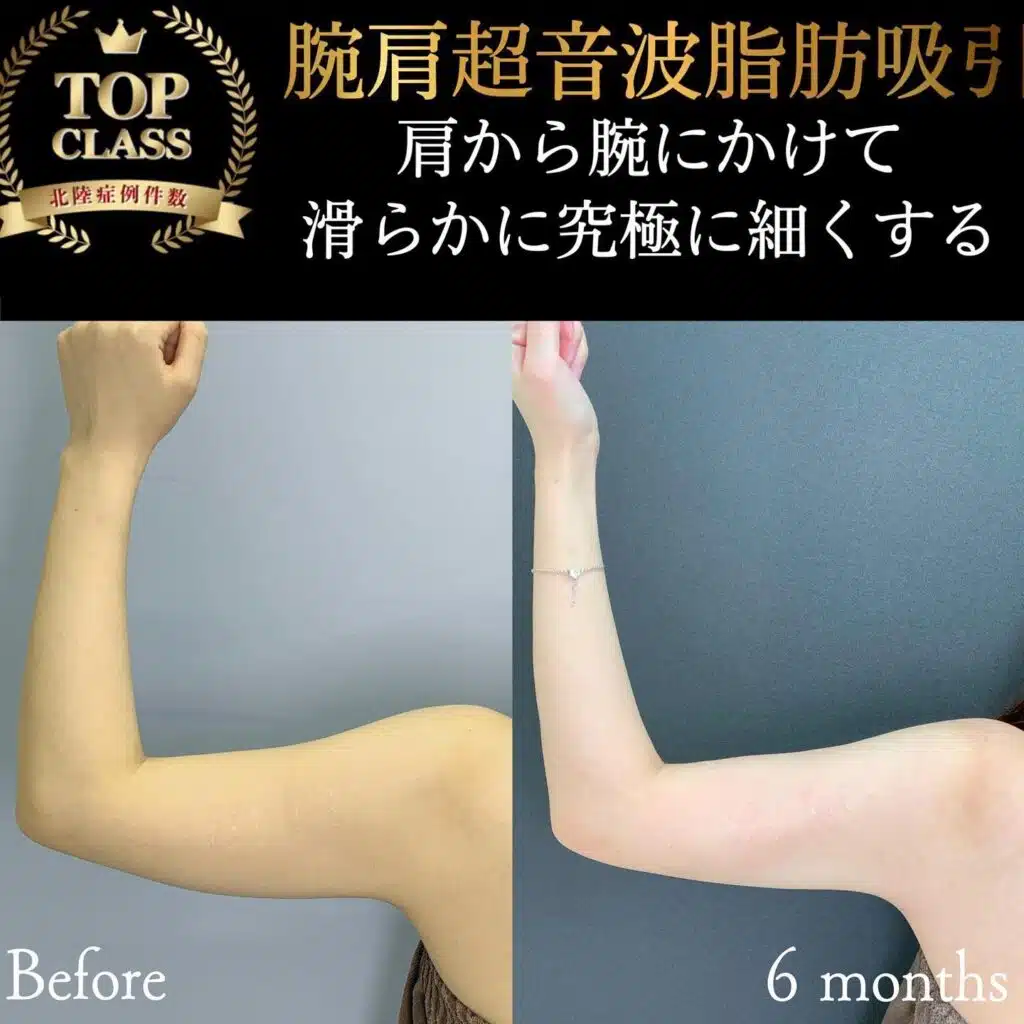腕肩超音波脂肪吸引　那覇