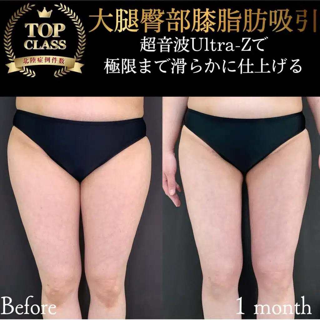 大腿臀部膝脂肪吸引　那覇