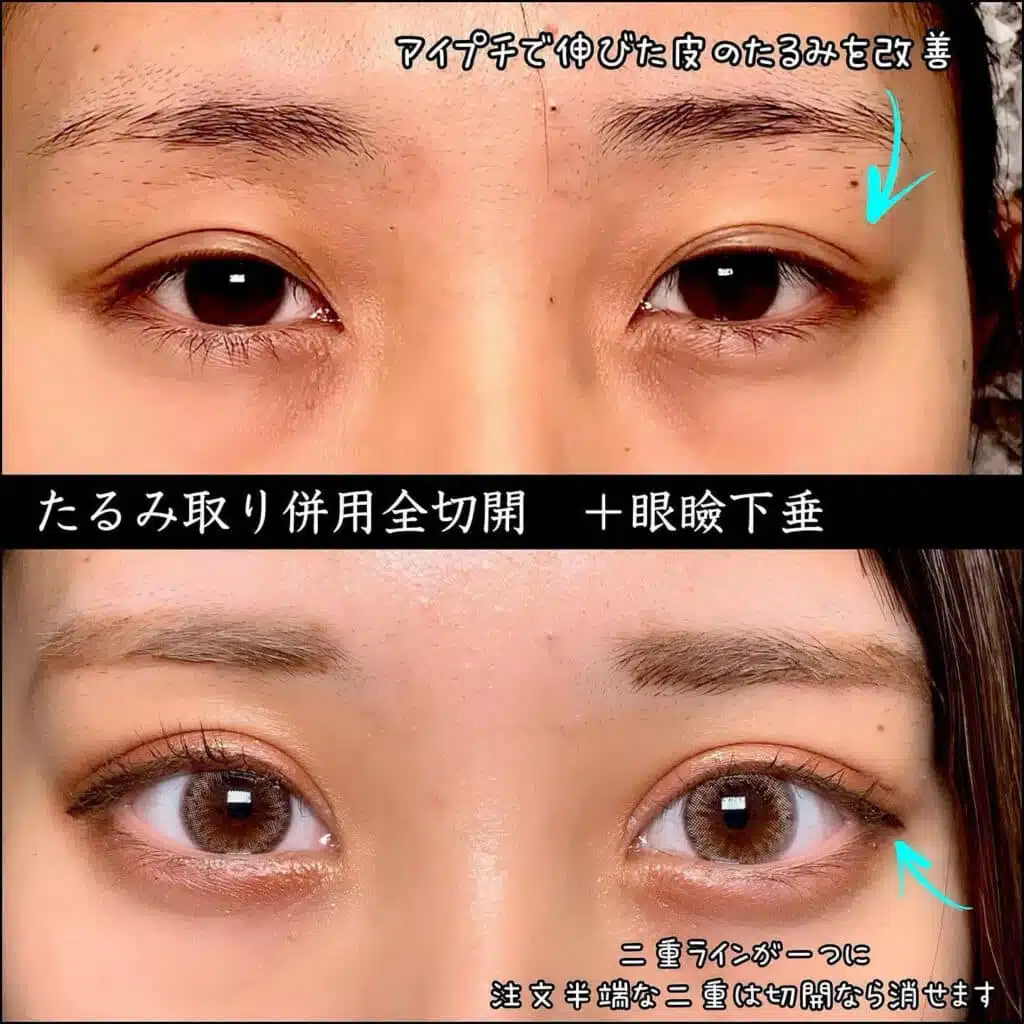 たるみ取り併用全切開+眼瞼下垂 那覇