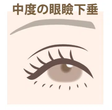 中度の眼瞼下垂 那覇