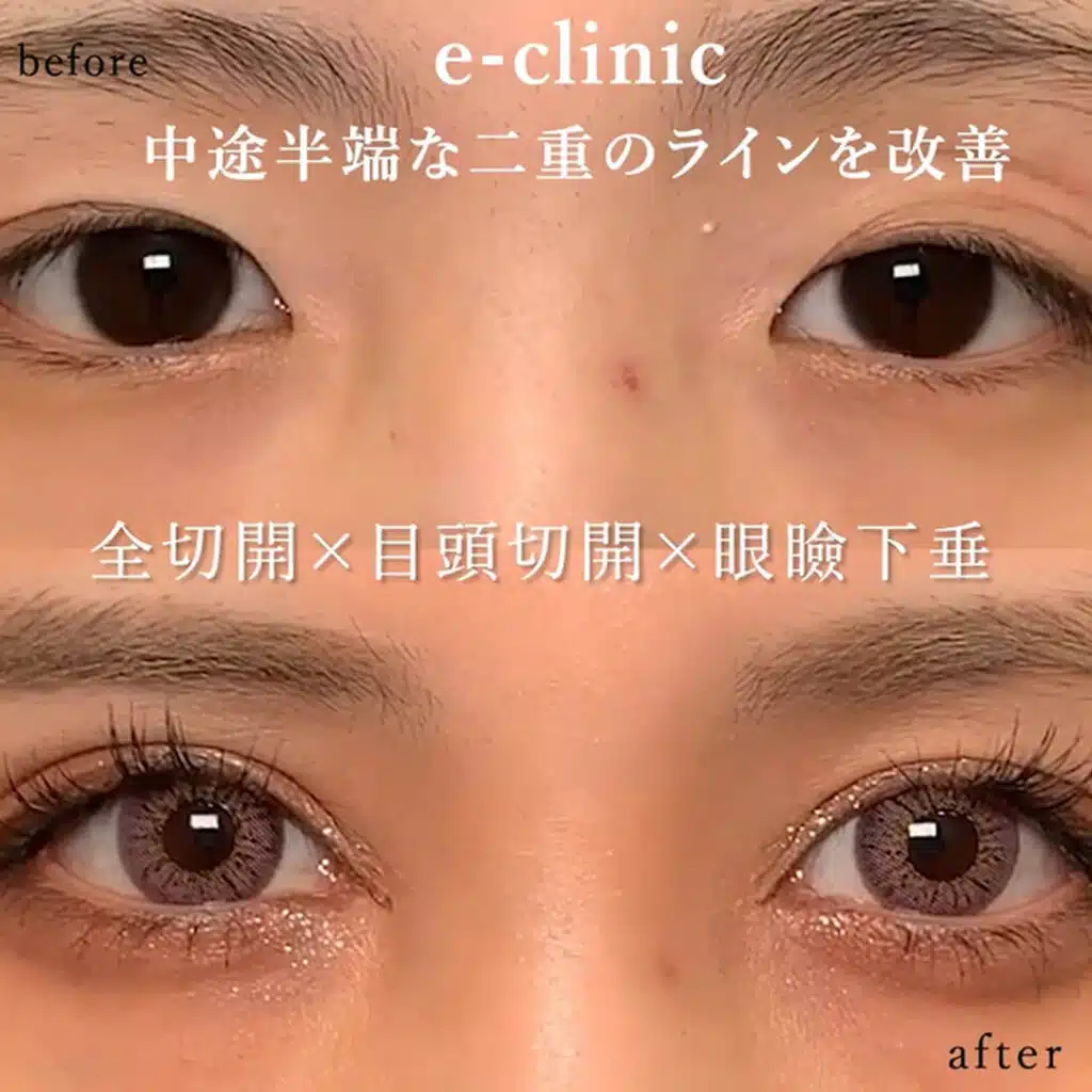 全切開×目頭切開×眼瞼下垂 那覇