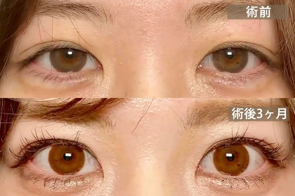 先天性眼瞼下垂 那覇