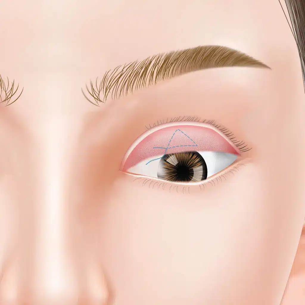 眼瞼下垂 手術方法 那覇