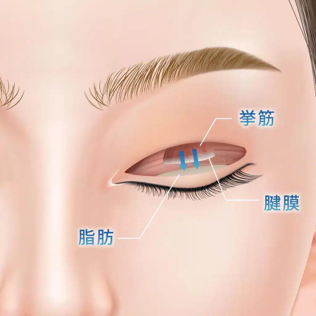 眼瞼下垂 手術方法 那覇