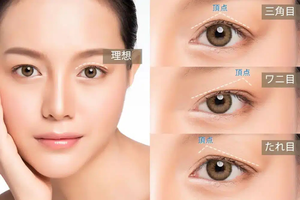 眼瞼下垂の失敗例の説明 那覇