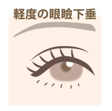 軽度の眼瞼下垂 那覇