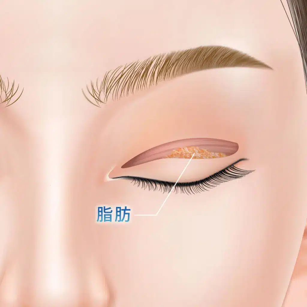 眼瞼下垂 手術方法 那覇