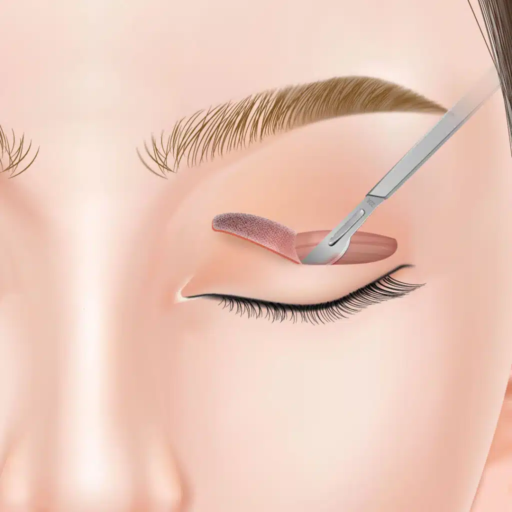 眼瞼下垂 手術方法 那覇