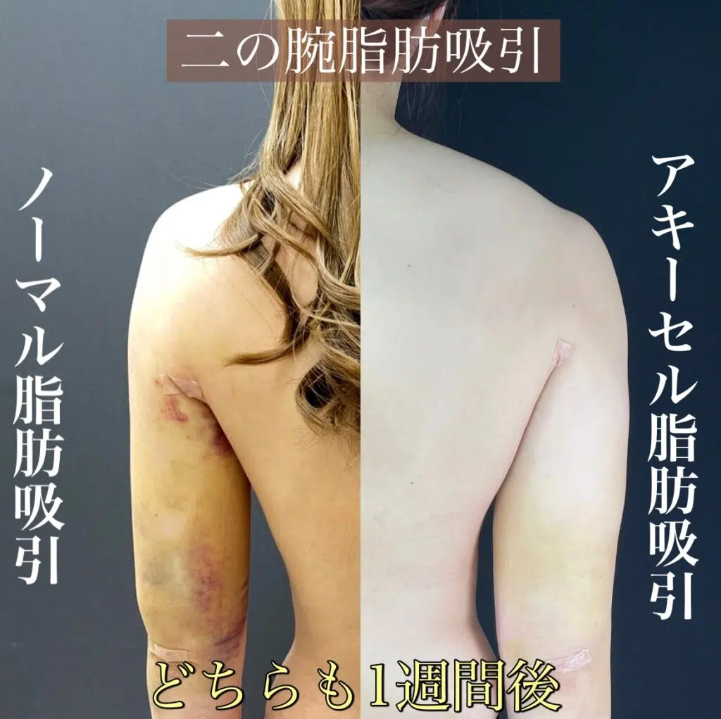 アキーセル脂肪吸引