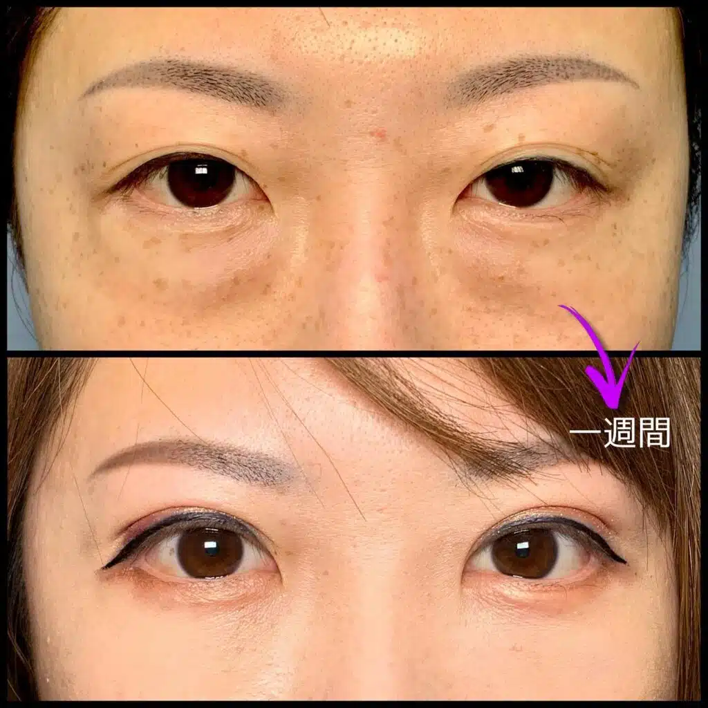 眼瞼下垂と全切開の傷跡の他院修正の1週間後の症例 那覇