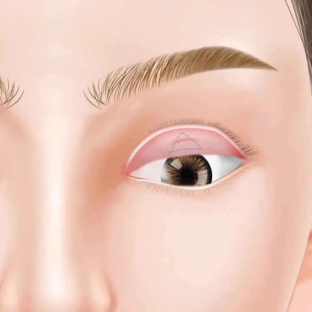 眼瞼下垂 手術方法 那覇