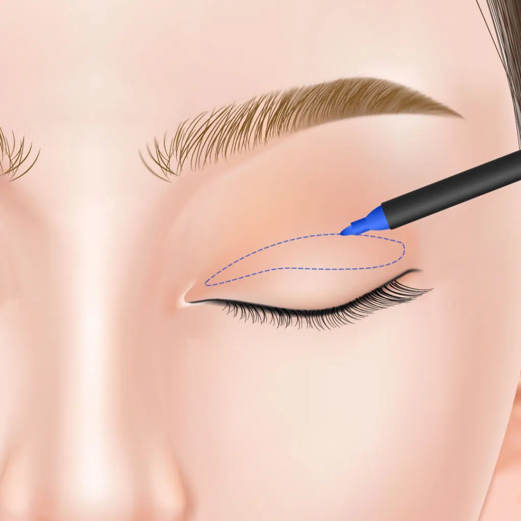 眼瞼下垂 手術方法 那覇