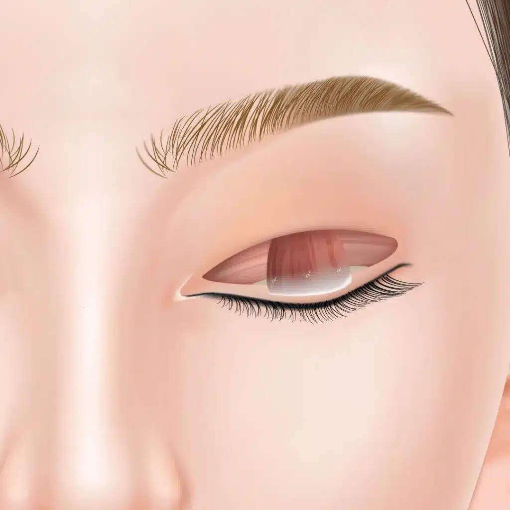 眼瞼下垂 手術方法 那覇