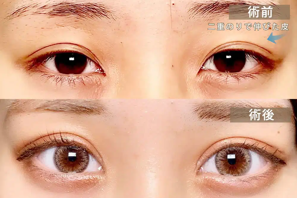 偽眼瞼下垂 那覇