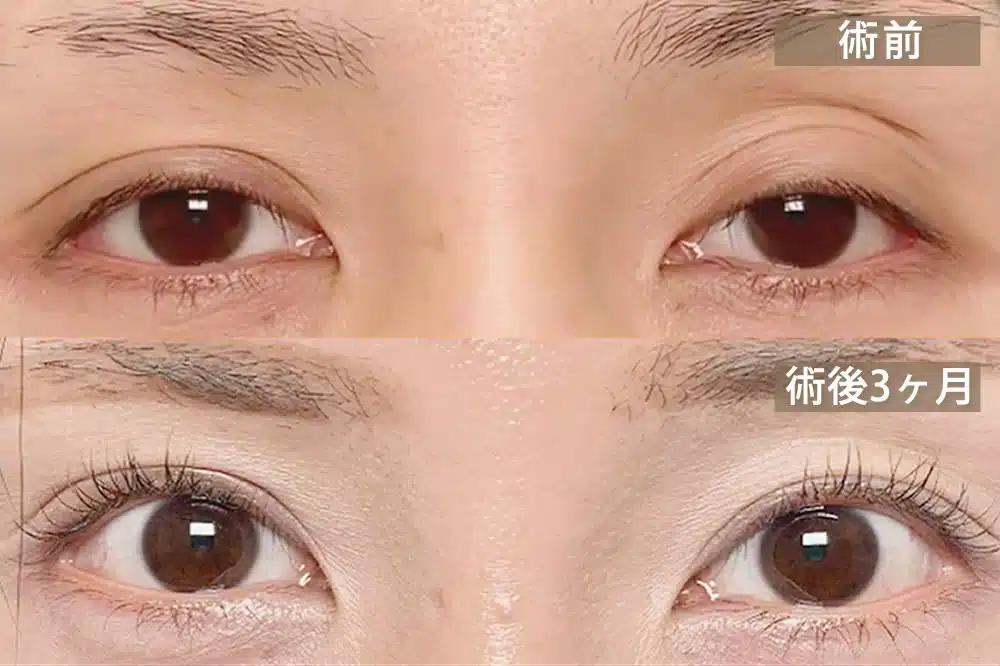 腱膜性眼瞼下垂(後天性眼瞼下垂) 那覇