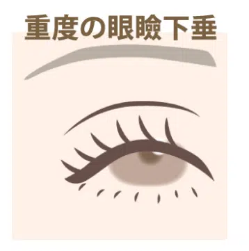 重度の眼瞼下垂 那覇